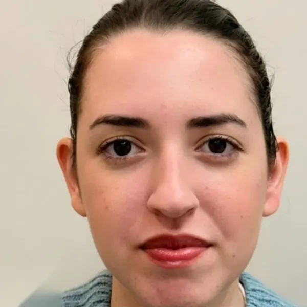 Paciente 1 antes da otomodelação, orelhas em vista frontal
